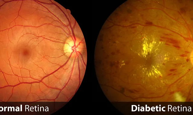 Advanced Therapies for Diabetic Eye Disease